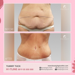 TUMMY-TUCK-05