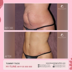 TUMMY-TUCK-06