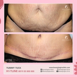 TUMMY-TUCK-07