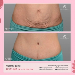 TUMMY-TUCK-09