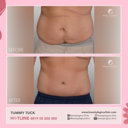 TUMMY-TUCK-10