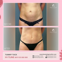 TUMMY-TUCK-11