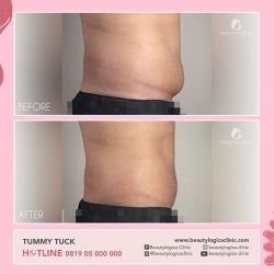 TUMMY-TUCK-12