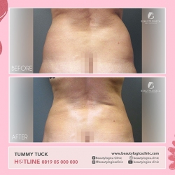 TUMMY-TUCK-13