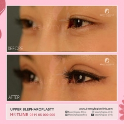 UPPER-BLEPHAROPLASTY-02