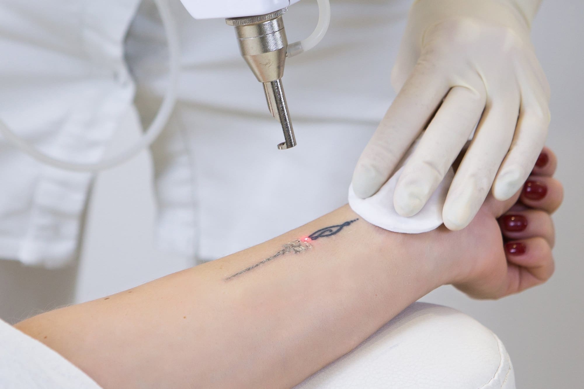Cara Menghilangkan / Hapus Tato Proses Resiko Hingga Biaya / tattoo removal
