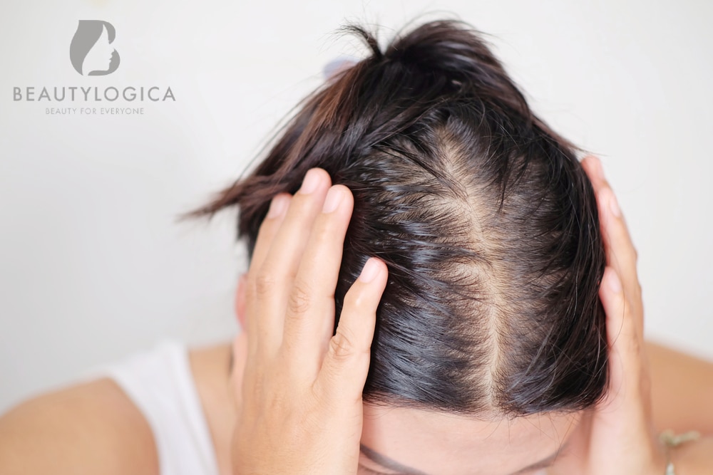 3 Cara Efektif untuk Atasi Masalah Rambut Menipis