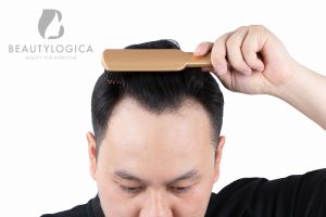 6 Cara Menumbuhkan Rambut Botak Paling Ampuh
