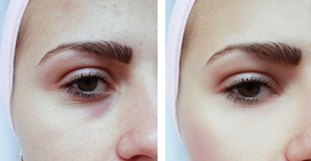 Harga Treatment Filler di Kantung Mata
