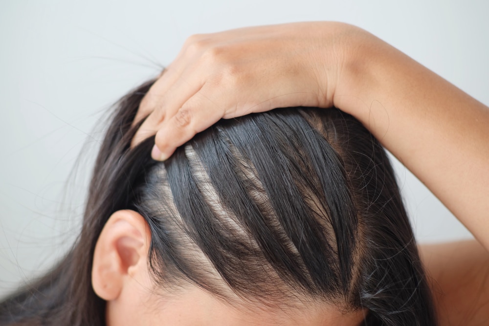 Rambut Menipis Bikin Gak Pede, Simak 3 Tips Dokter Berikut ini