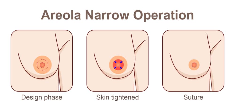 areola reduction - operasi mengecilkan lingkaran puting