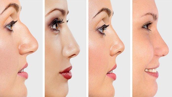 Filler Hidung Termurah di Medan