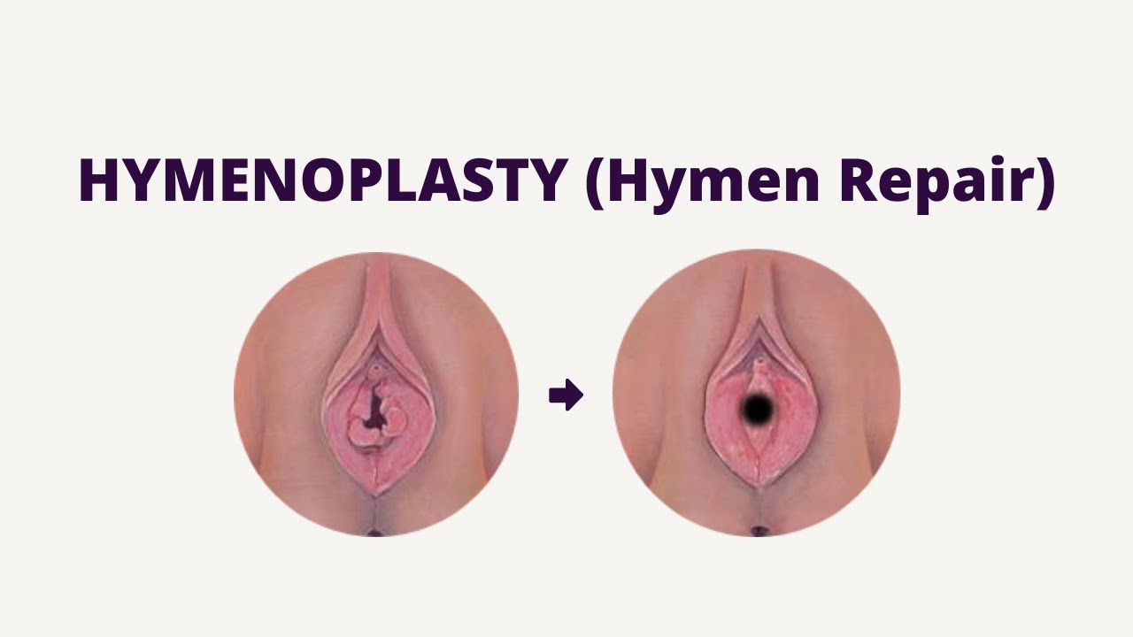 Hymenoplasty murah Jakarta
