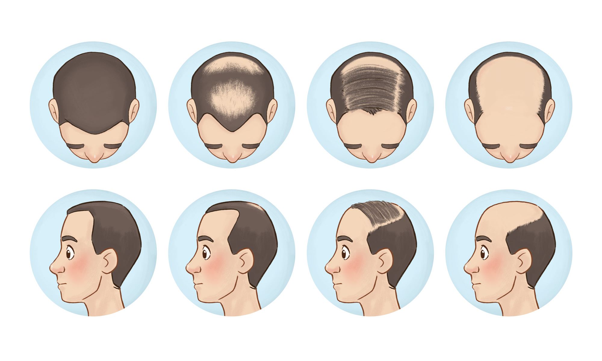 Mengatasi Kebotakan Rambut Pria Murah