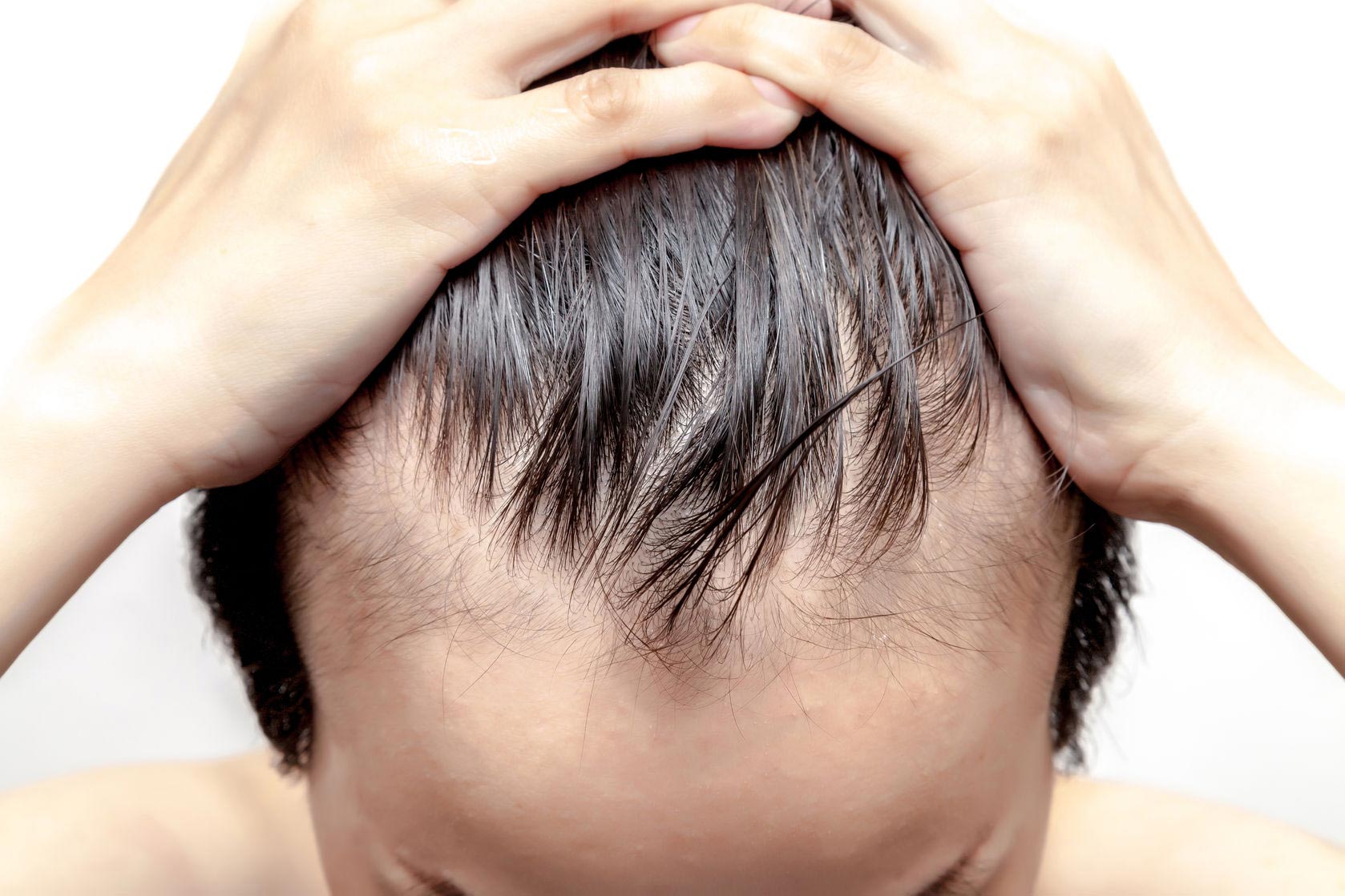 Mengatasi Kebotakan Rambut Pria