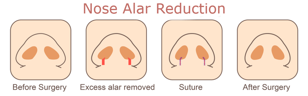 Operasi Mengecilkan Cuping Hidung - Nose Alar Reduction