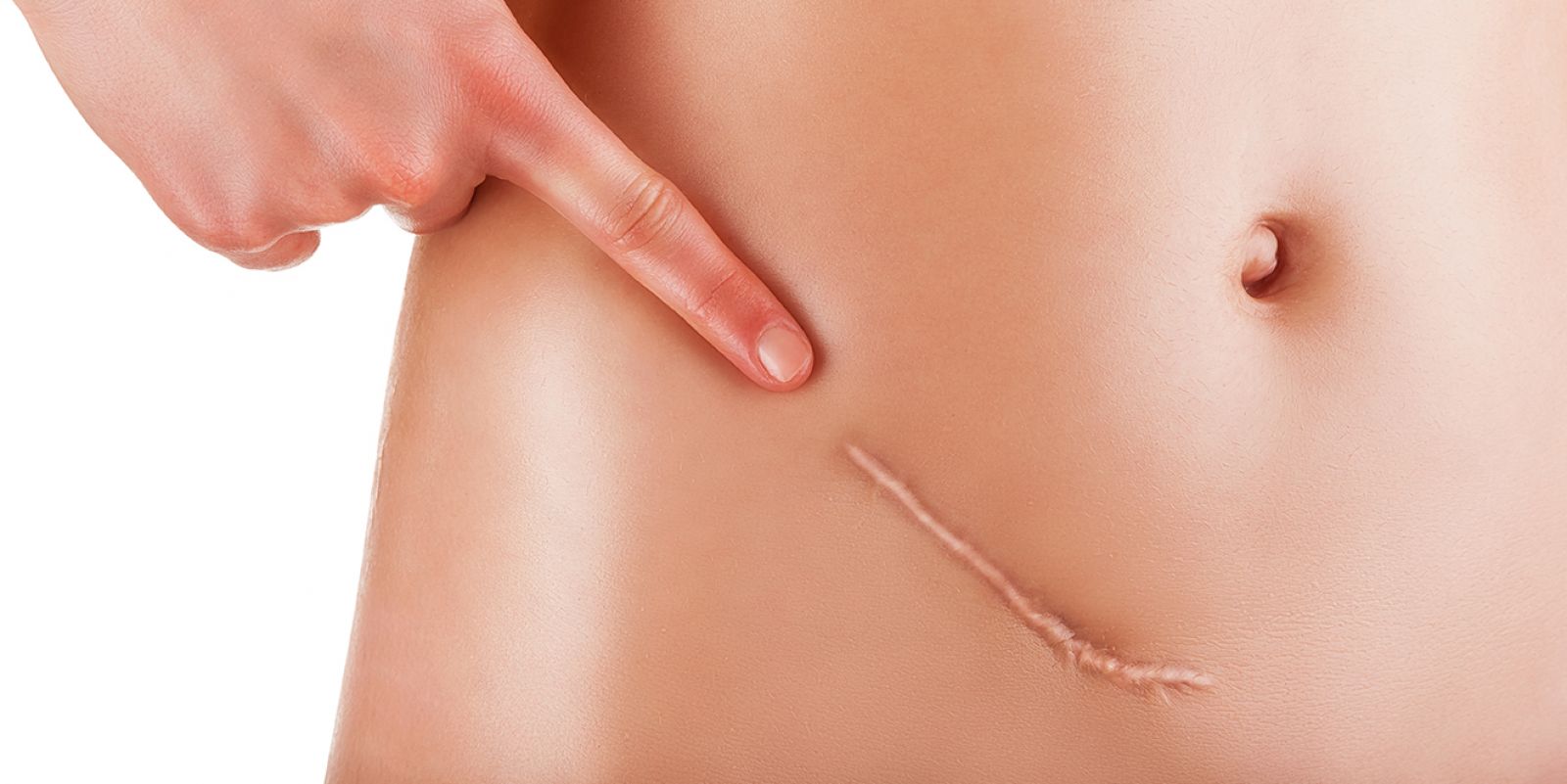 biaya operasi keloid