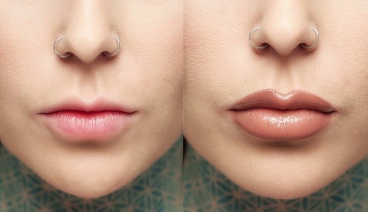 Filler Bibir Murah