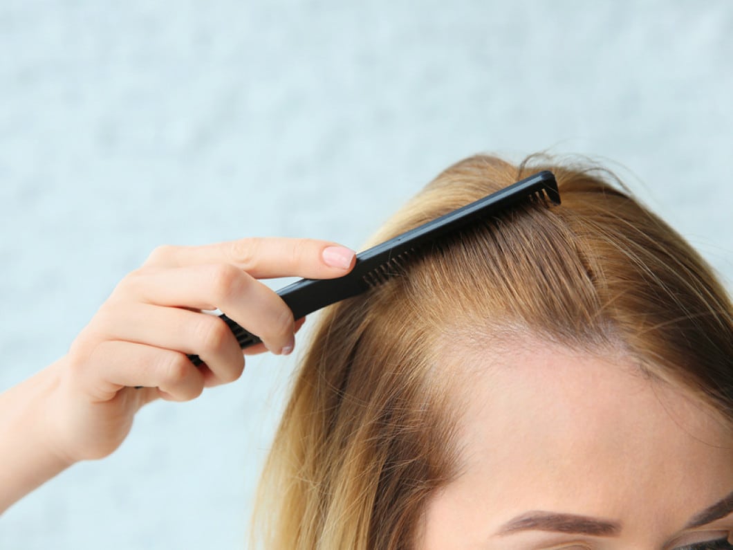 kebotakan rambut wanita