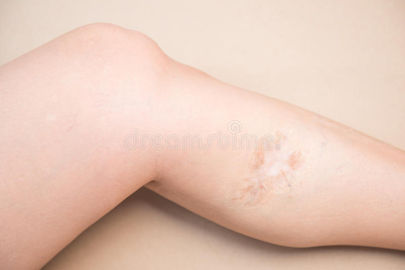 menghilangkan keloid ampuh