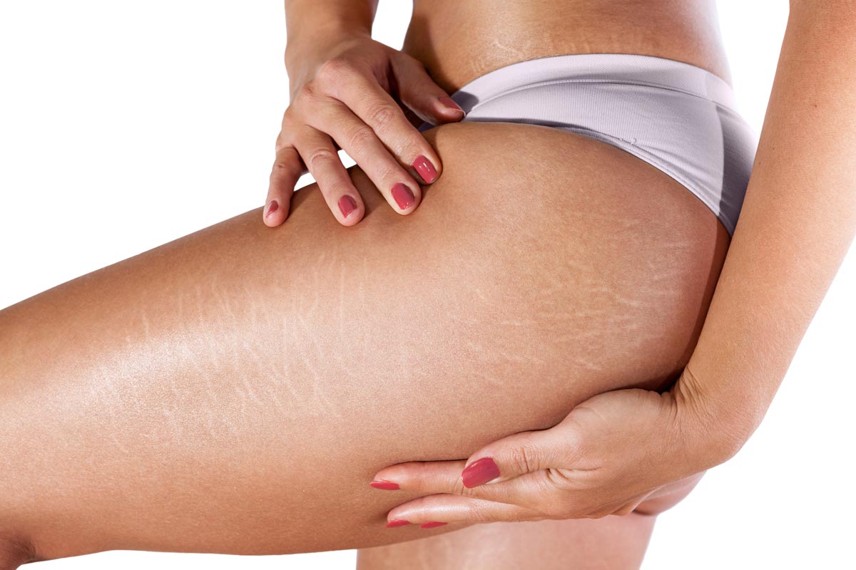 menghilangkan stretch mark murah