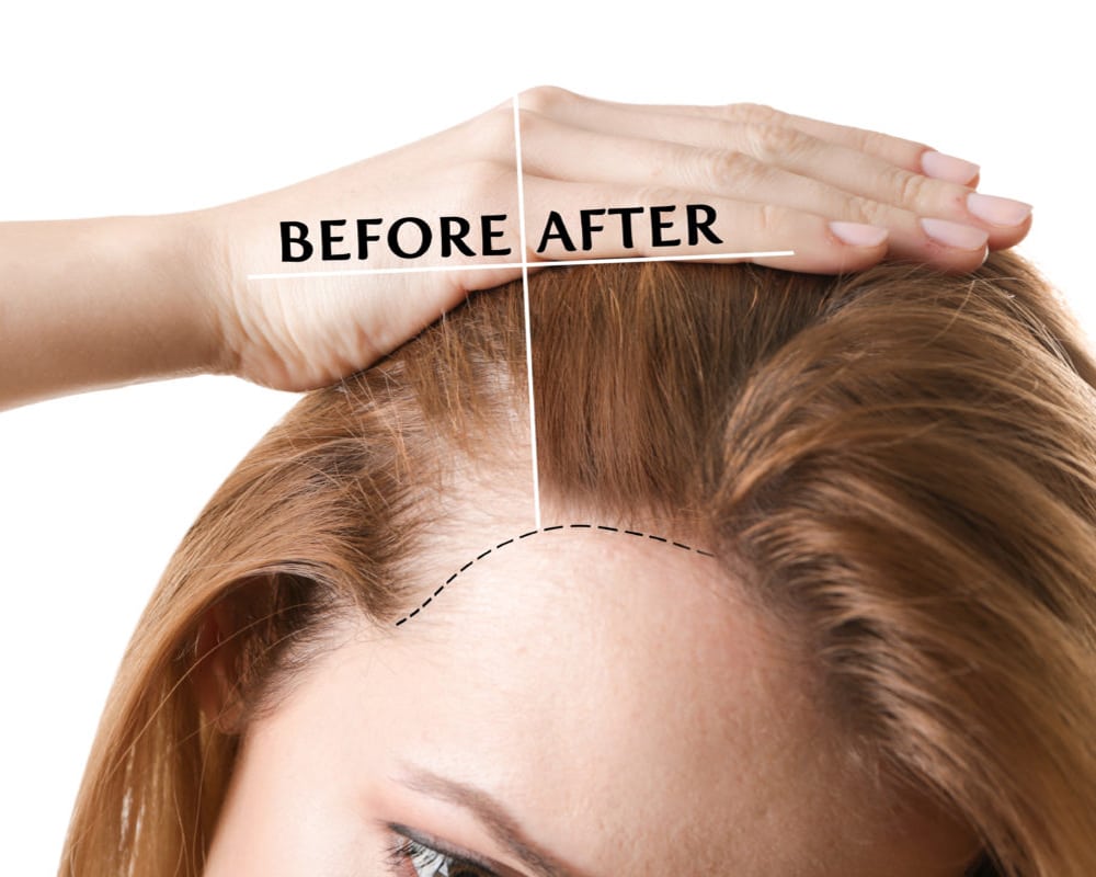 operasi transplantasi rambut