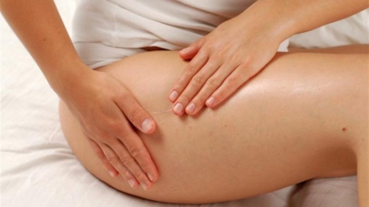 pengobatan stretch mark