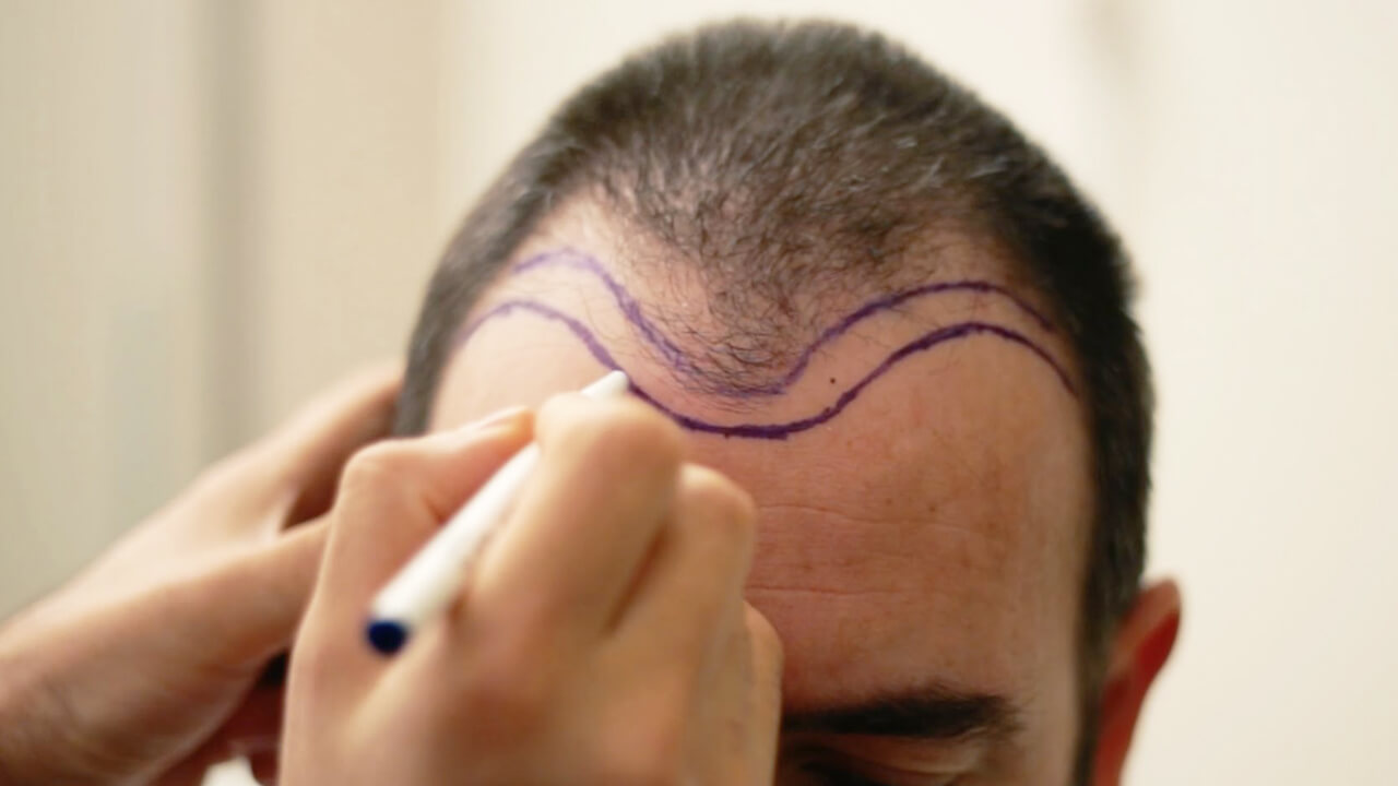 transplantasi rambut