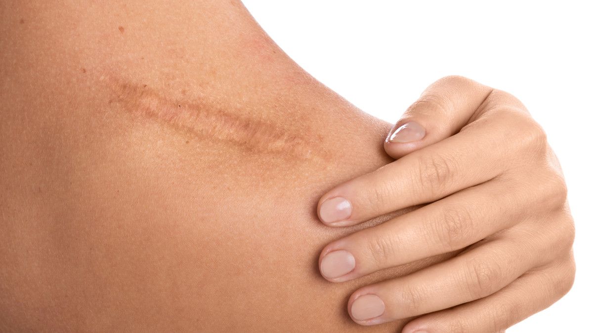 Perawatan Bekas Luka Keloid Terbukti Ampuh di Klinik Kecantikan