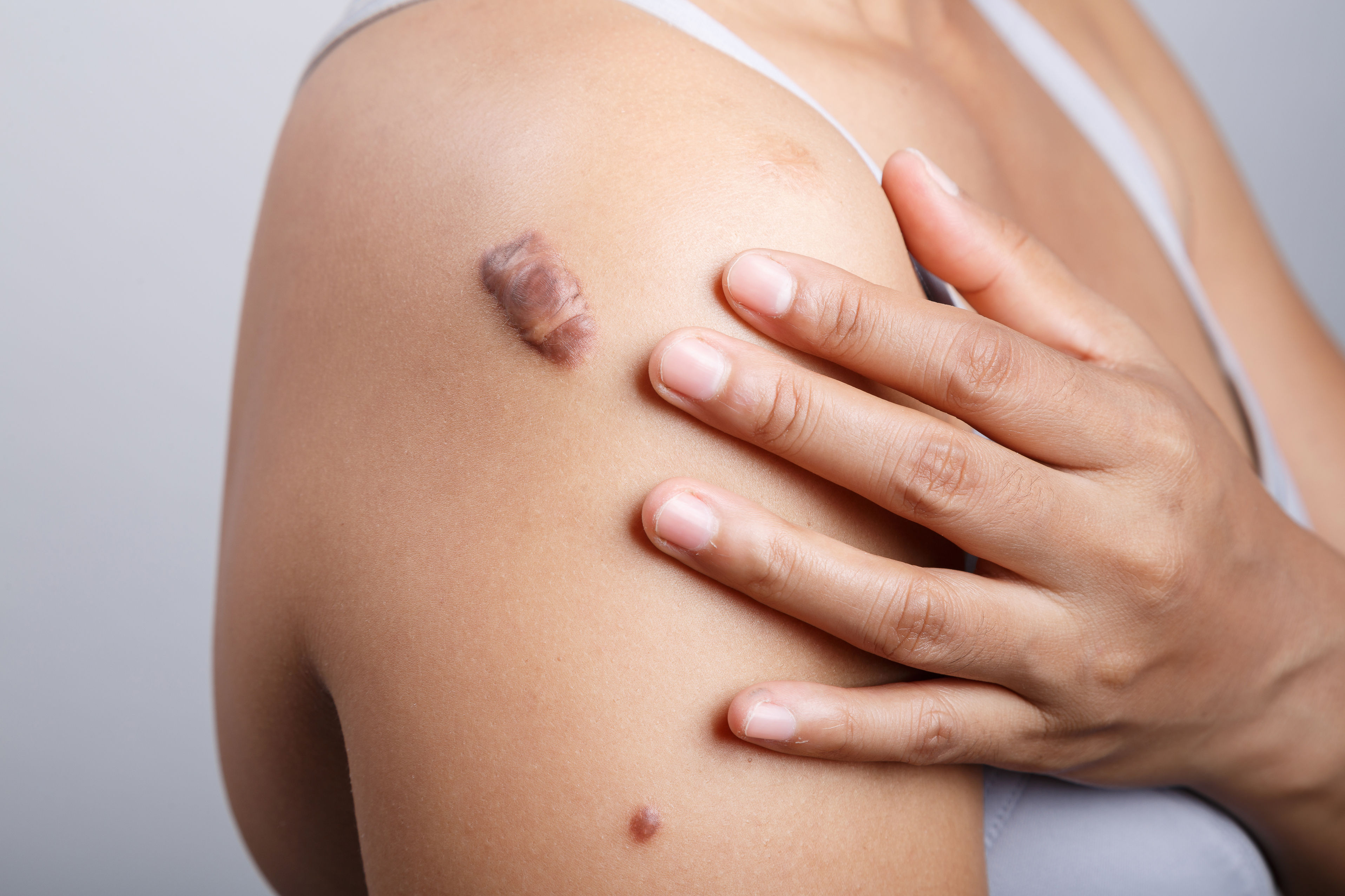 Perawatan Bekas Luka Keloid