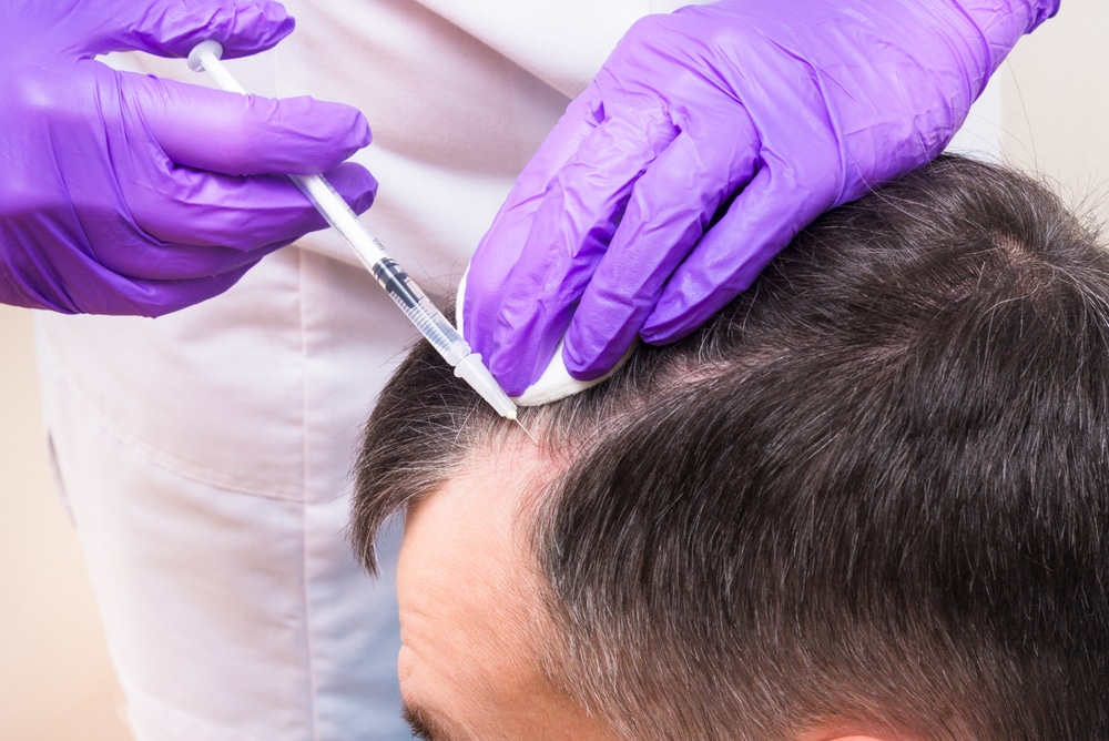 Hair PRP untuk Menebalkan Rambut