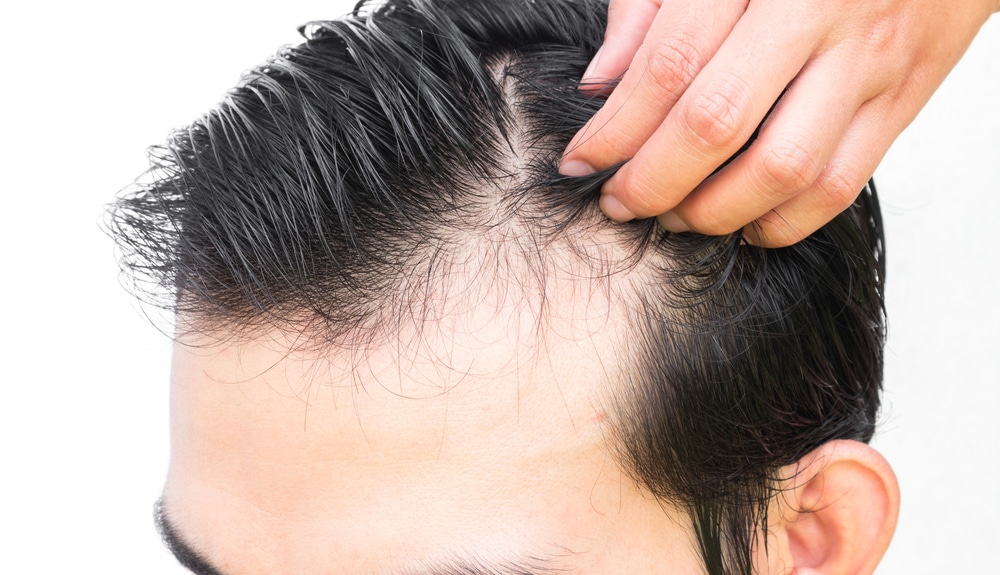Penyebab Penipisan Rambut Pria