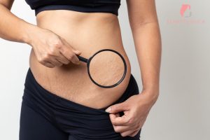 Apakah Stretch Mark Bisa Hilang_