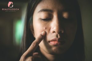 Cara Menghilangkan Jerawat Batu