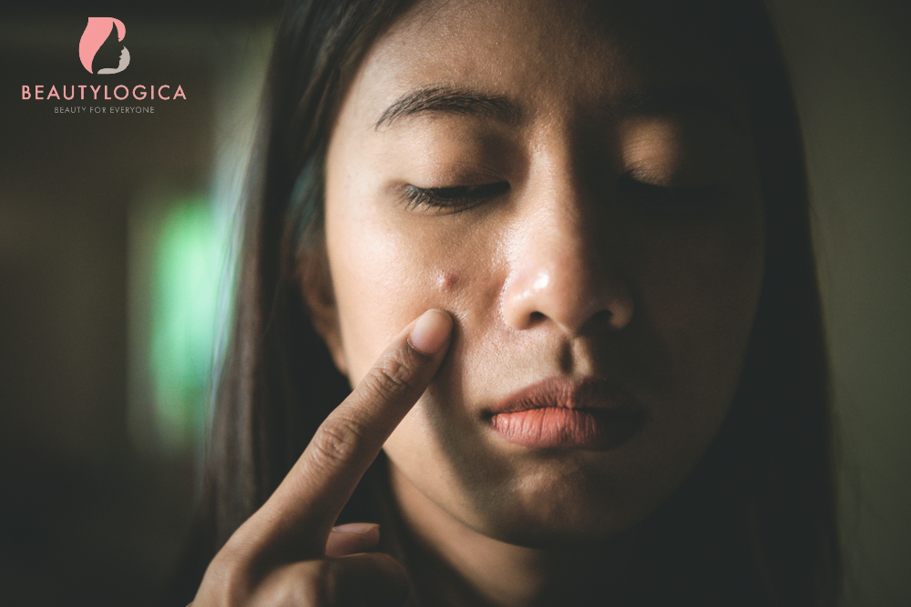 Cara Menghilangkan Jerawat Batu