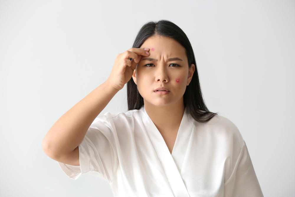 Cara cepat mencegah dan mengatasi jerawat yang meradang