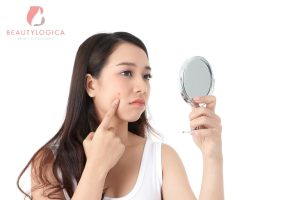 Cara mengatasi jerawat batu di pipi