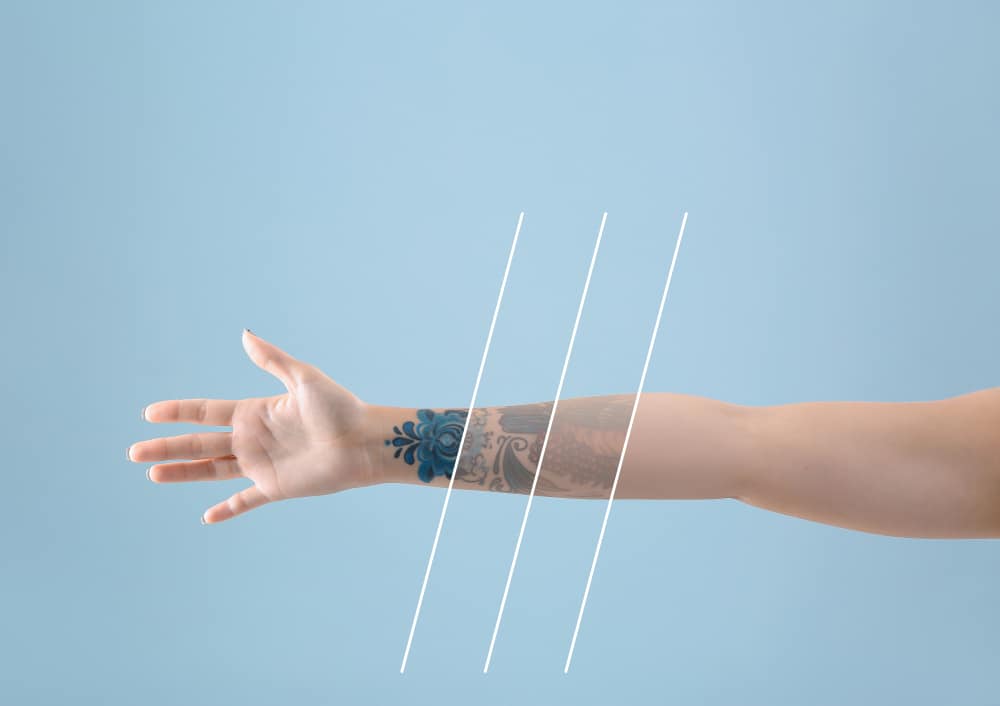Hapus tato permanen dengan laser