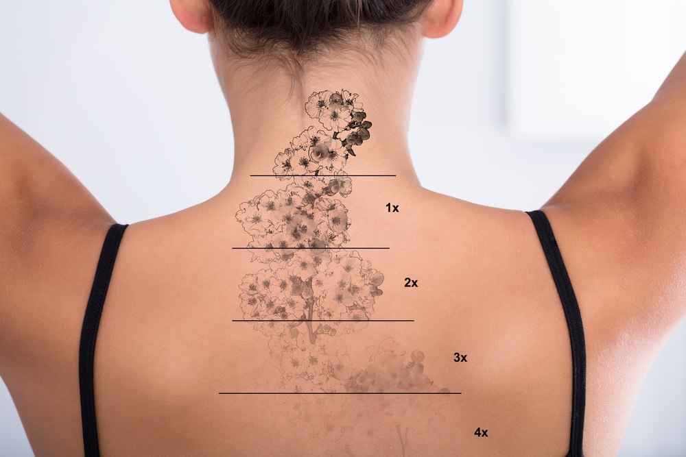 Laser Tattoo Removal JakartaLaser Tattoo Removal Jakarta