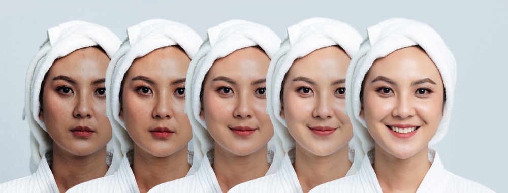 before after perawatan laser
