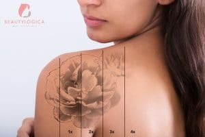 cara menghilangkan tato permanen tanpa merusak kulit