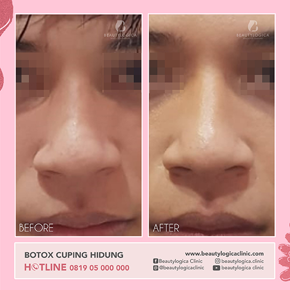 BEFORE AFTER SUNTIK BOTOX ADALAH SEBAGAI BERIKUT