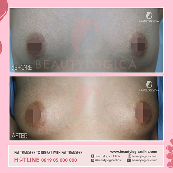 BREAST AUGMENTATION WITH FAT TRANSFER