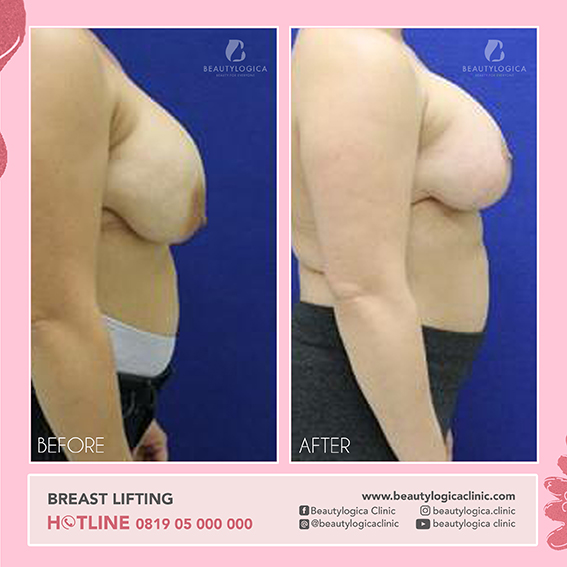 BEFORE AFTER BREAST LIFTING