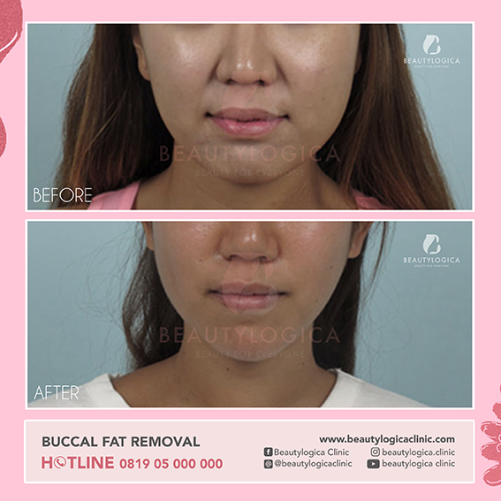 BEFORE AFTER BUCCAL FAT REMOVAL