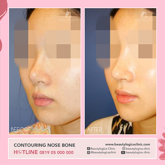 BEFORE AFTER Contouring Nose Bone - Operasi contour hidung