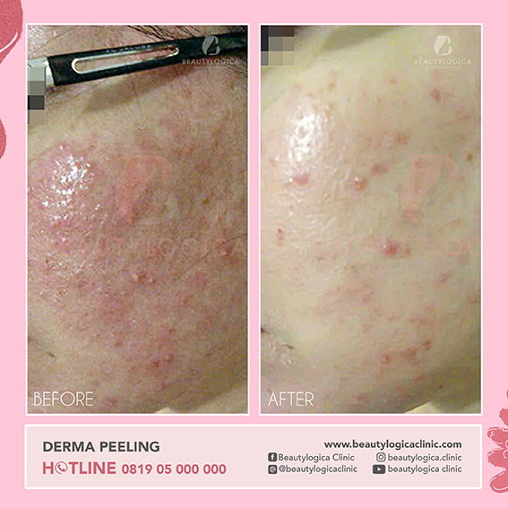 BEFORE AFTER DERMA PEELING