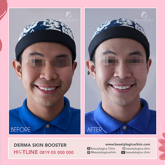 BEFORE & AFTER DERMA SKIN BOOSTER