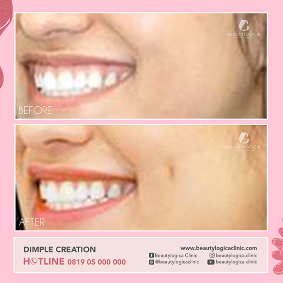 BEFORE AFTER DIMPLE CREATION - operasi lesung pipi