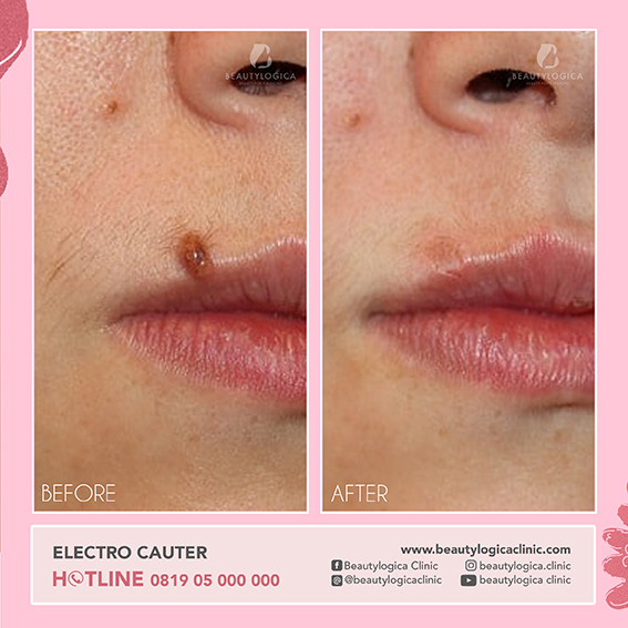 BEFORE AFTER ELECTROCAUTER